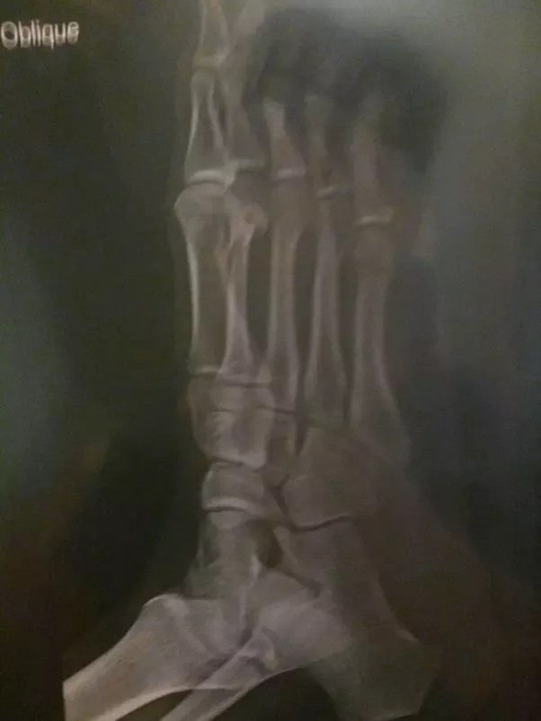 Growth plates are the area of the growing tissues at the each ends of the long bones in children and adolescents. How To Tell If Your Growth Plates Have Closed Quora