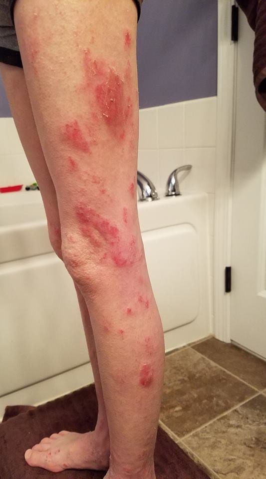 Research has shown that exposure to uv radiation from the sun may help reduce skin inflammation, thereby alleviating some of the dryness, itching, . Do Tanning Beds Help With Eczema Quora