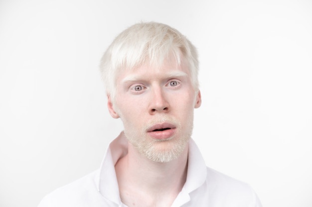 Apa itu albino? Jelaskan melalui beberapa gambar. Apakah ini keajaiban? -  Quora
