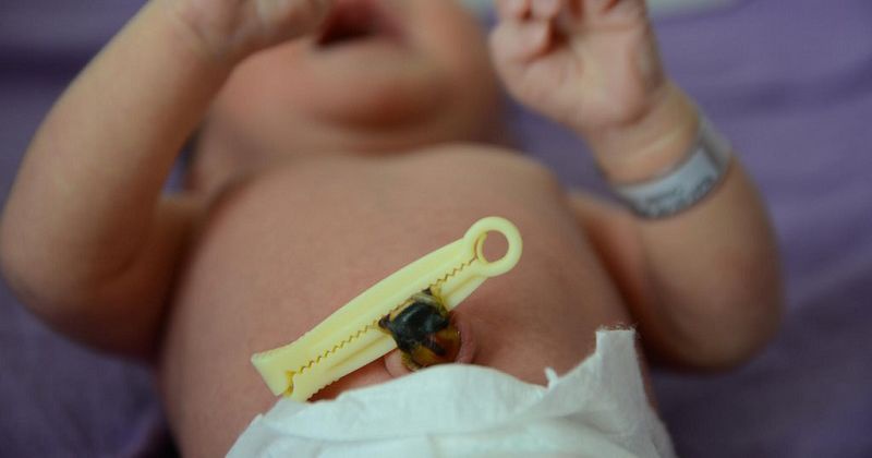 Bagaimana cara merawat tali pusar bayi yang sudah lepas? - Quora