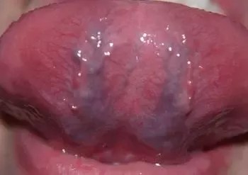 Leukoplakia Causes Symptoms And Diagnosis