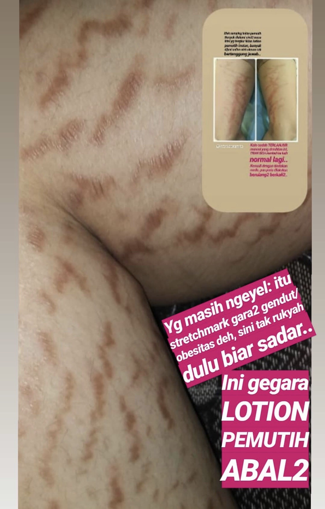 Apa efek negatif dari penggunaan pemutih kulit? - Quora