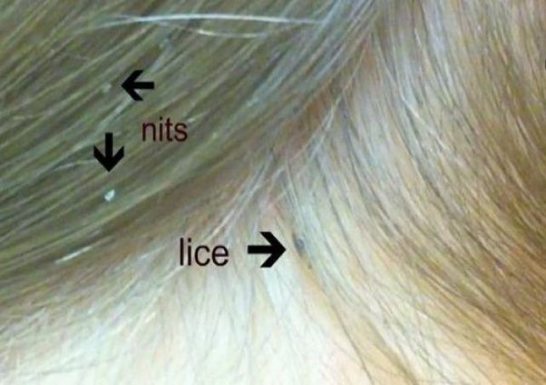 We did not find results for: What do lice and nits look like in the hair? - Quora