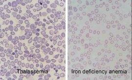 Tests that help healthcare providers find the underlying cause of anemia and other conditions. How will we distinguish between thalassemia and iron