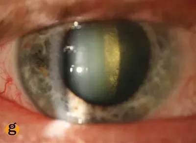 Significant posterior subcapsular cataract (psc) was the presence, in at least one eye, of a locs iii score of ⩾2 for p. Ophthalmology Does Visual Acuity Improve After Pin Hole Testing In Posterior Capsular Opacity Quora