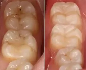 How To See A Cavity Like A Dentist Kingstowne Family Dentistry