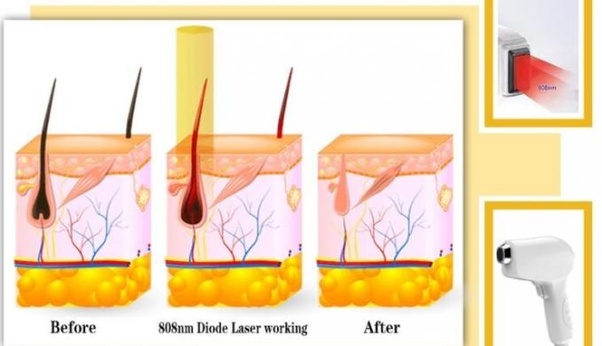 What Laser Type Works Best For Laser Hair Removal Ruby