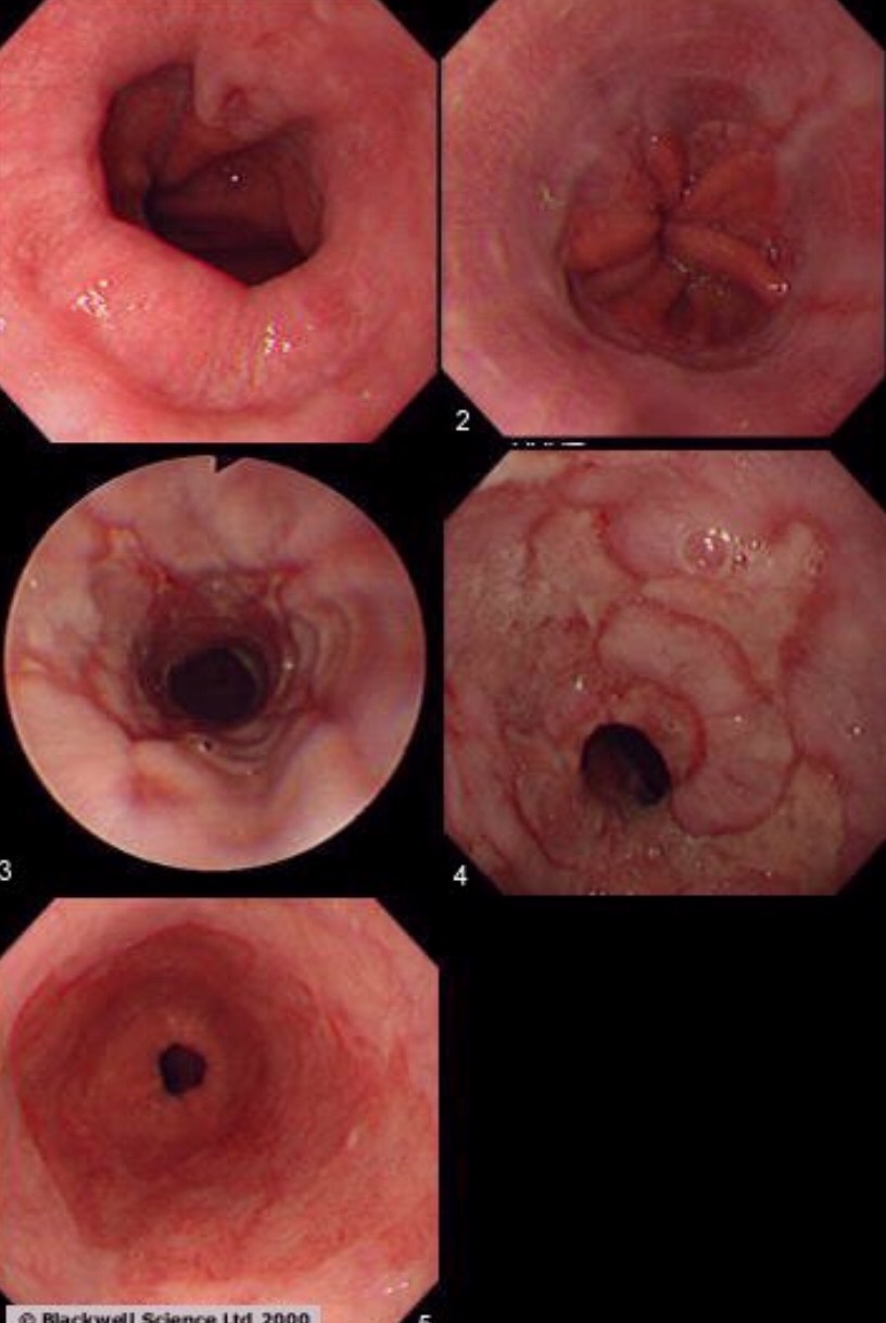 · decreased swallowing during sleep . Why Does My Boyfriend Still Have Heartburn Spitting Up Horrific Heartburn Pain Everyday Every Night Quora