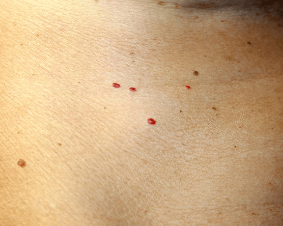 Small Blood Like Spots On Skin Tbmtb