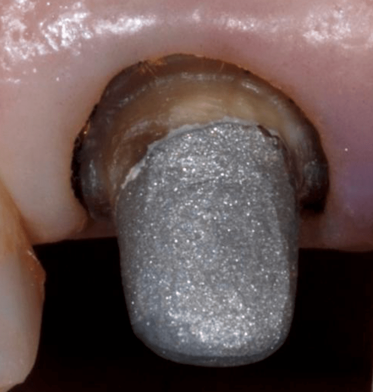 Dark Tooth Treatment Internal Tooth Bleaching Black Teeth Treatment