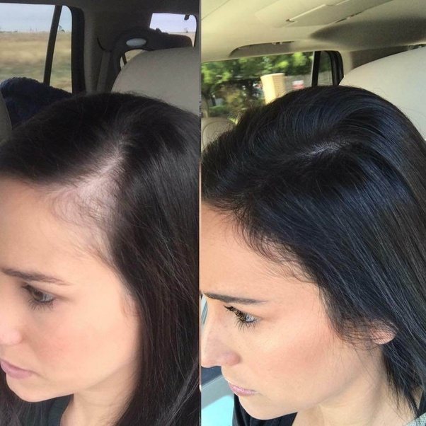 Here, a celeb hairstylist and trichologist share their expert tips and tricks to fix a thinning hairline. Can I reverse hair loss and actually regrow hair on a receding hairline? - Quora