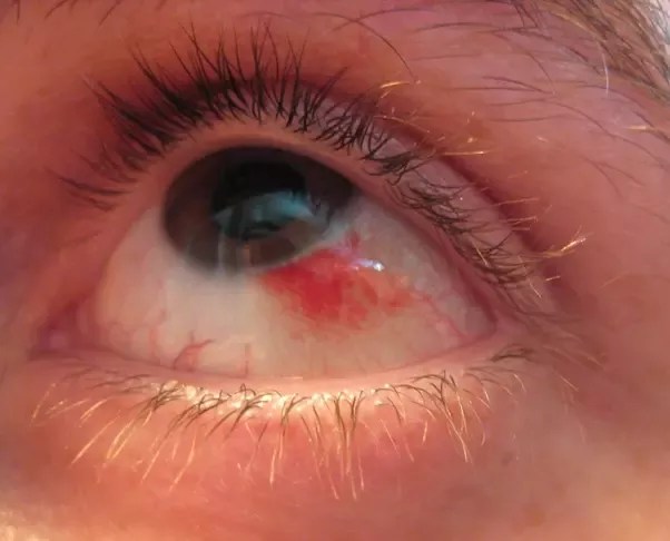 The urge to wipe your eyes may never have been stronger, but hold off for as long as you can. My Right Eye Turned Red Although It S Not Itchy Or Pain What S Happening Quora