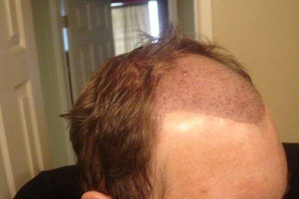 Many women are affected by fphl. What are the treatments available for diffuse hair lose ...