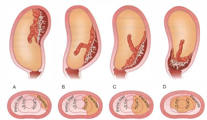 Apakah setiap ibu hamil yang divonis mengalami placenta orevia akan  berujung di meja operasi untuk tindakan operasi caesar? - Quora