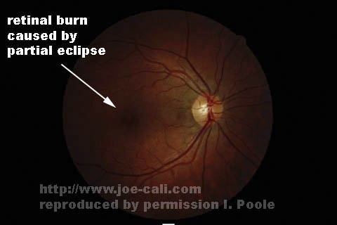 Mengapa kita tidak boleh menatap matahari secara langsung saat gerhana? Apa  bedanya dengan menatap matahari pada saat normal? - Quora