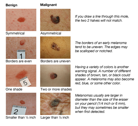 Hello all, i was recently diagnosed with malignant melanoma. Are There Symptoms Of Skin Cancer Other Than Strange Colored Shaped Moles I Am A Teen In Good Health And Saw A Mole With Two Different Colors Today Could I Have Late Stage