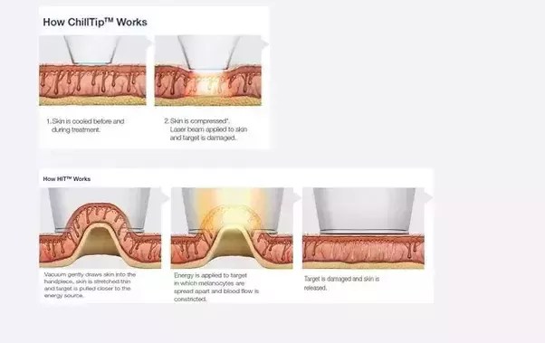 How To Get A Laser Treatment For Acne With Complete Results