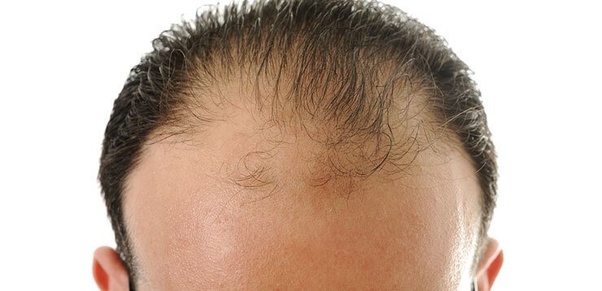 Can Microneedling Cause Temporary Hair Shedding / What is Shock Hair Loss After Surgery? - Articles - Sara : This can cause serious health ramifications, and even death.