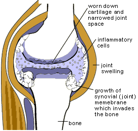 Apa itu peradangan? - Quora