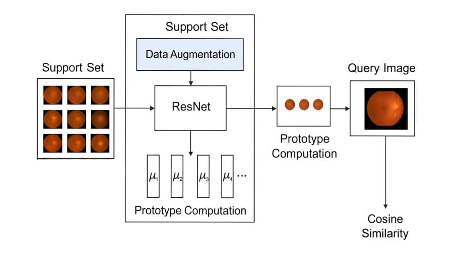 Balanced Few-Shot Retina Diagnosis: Fixing Imbalance with Prototypical Networks (2026)