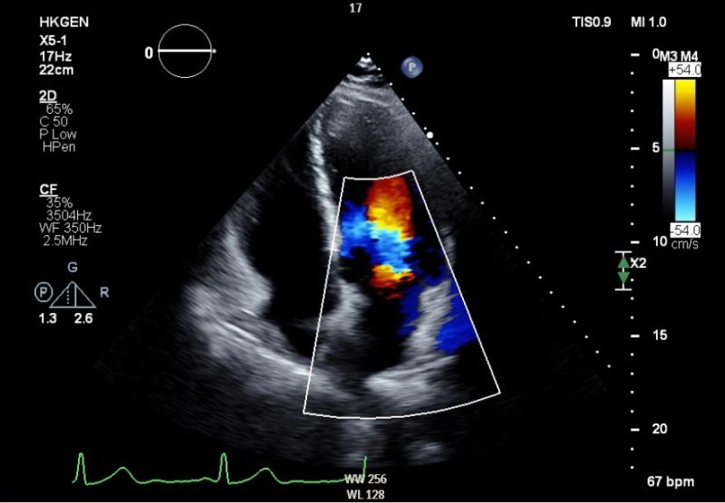 Heart Failure Treatment Advances Us2 Ai - Best Minimal Wallpapers in Full HD