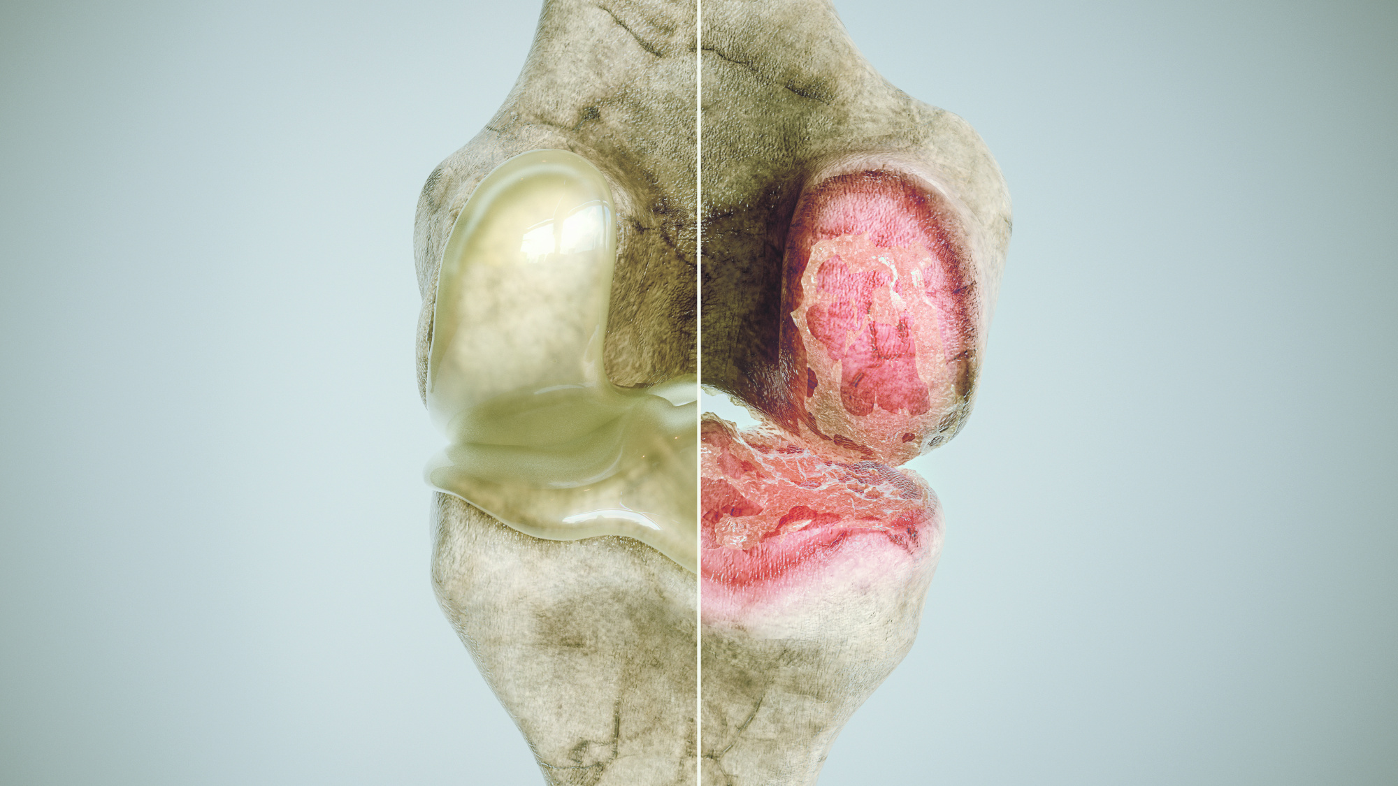 Arthritis