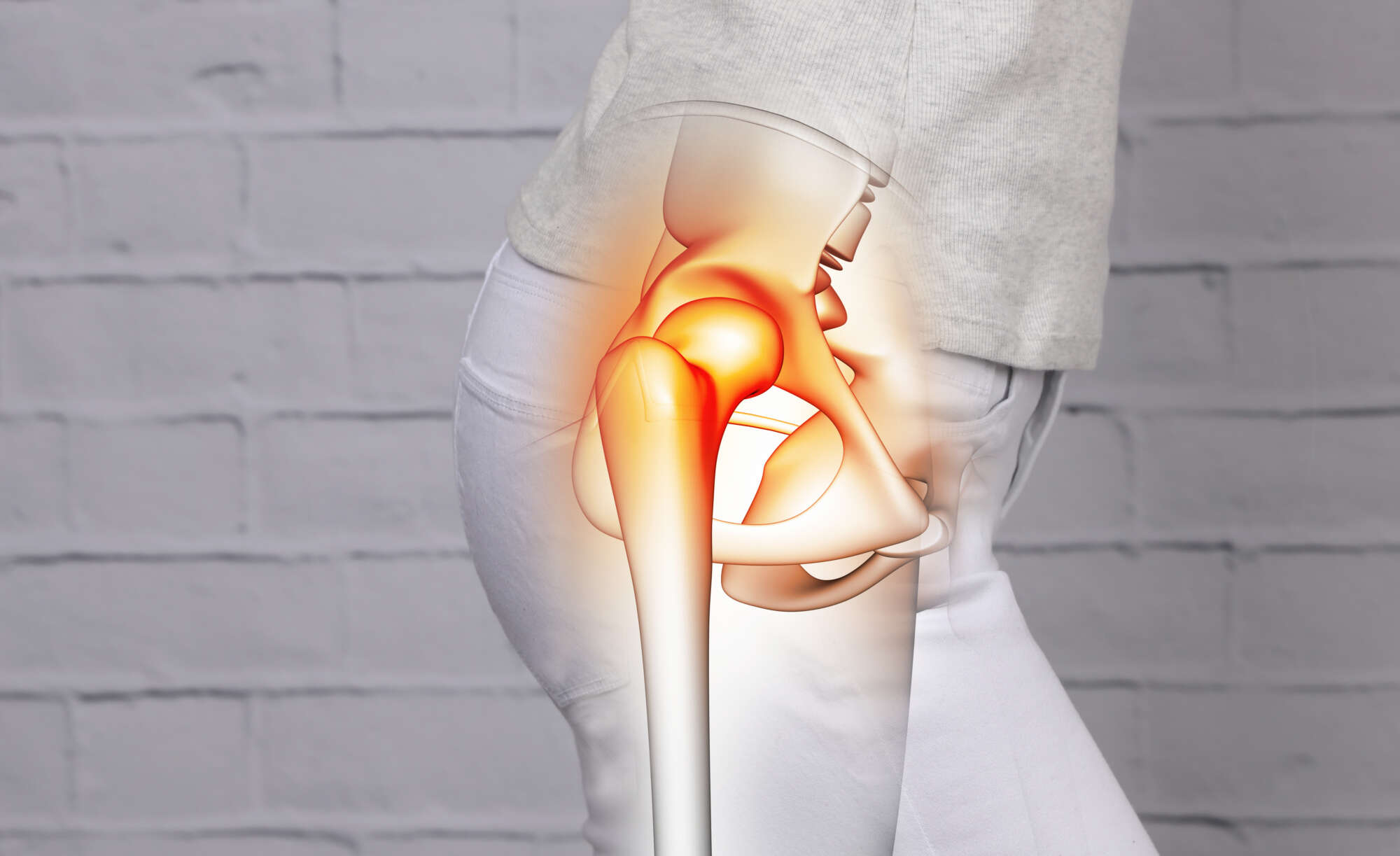 Trochanteric Bursitis - Hip - Conditions - Musculoskeletal - What We Treat  