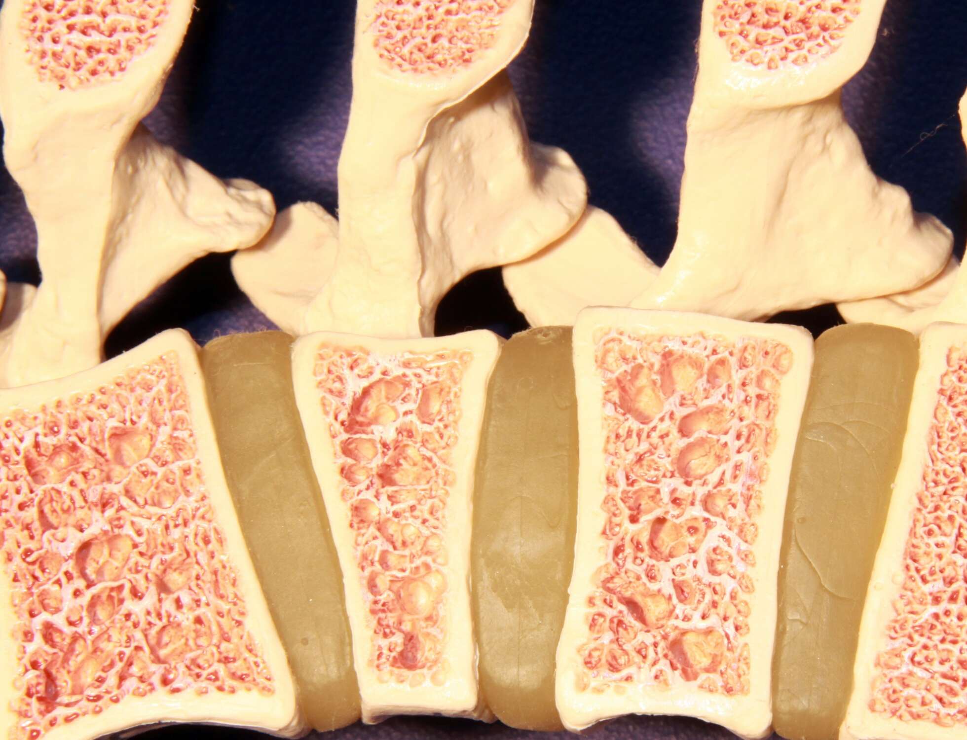 Osteoporosis: Complete management featured image