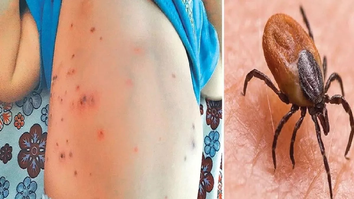 Scrub Typhus kills 5 in Odisha 9 in Shimla