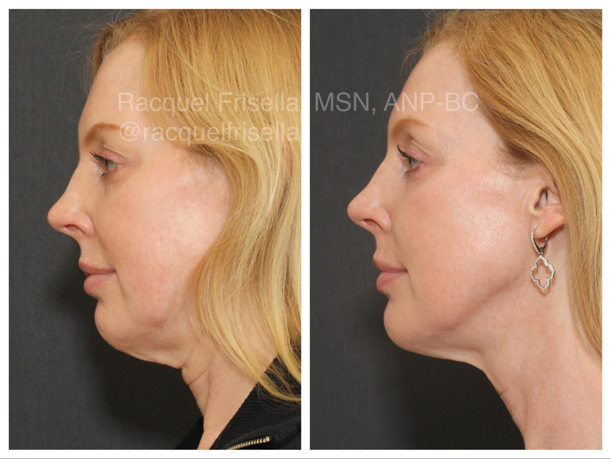 ultherapy neck
