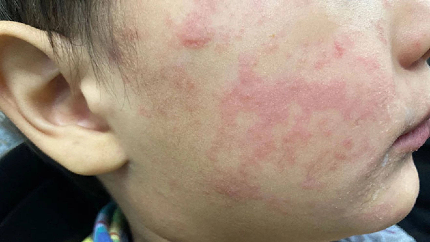 Six Confirmed Measles Cases, 14 Presumed Infected Across Upstate NY