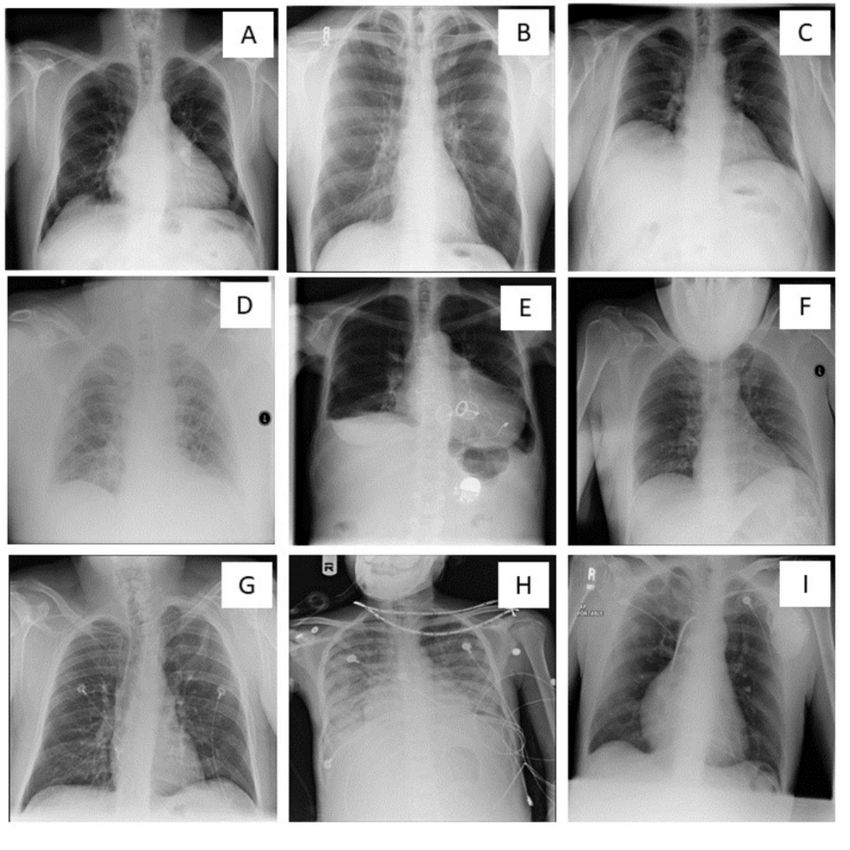 Optimal vs Suboptimal Chest X-Rays