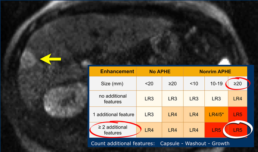 How to build a table: The Radiology Assistant Li Rads