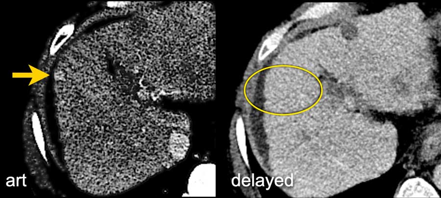 The series is edited and supervised by our associated editor dr. The Radiology Assistant Li Rads