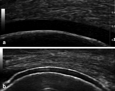 Sonography is seen as a diagnostic tool of acute and chronic gout in recent days. Crystal Induced Arthritis Radiology Key