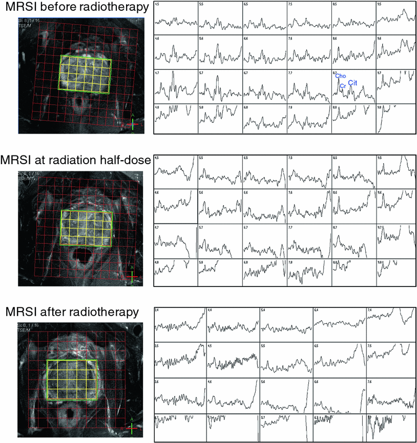Imaging and MR Spectroscopy in Prostate Cancer Radiology Key