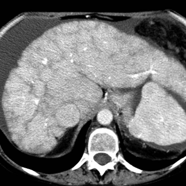 Passive Hepatic Congestion | Radiology Key