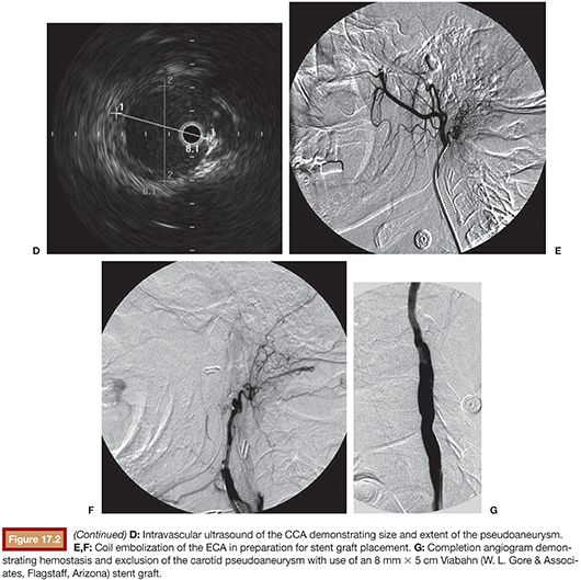 Carotid Blowout Syndrome | Radiology Key