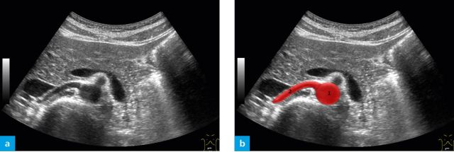 Ultrasound investigation of the right renal artery 