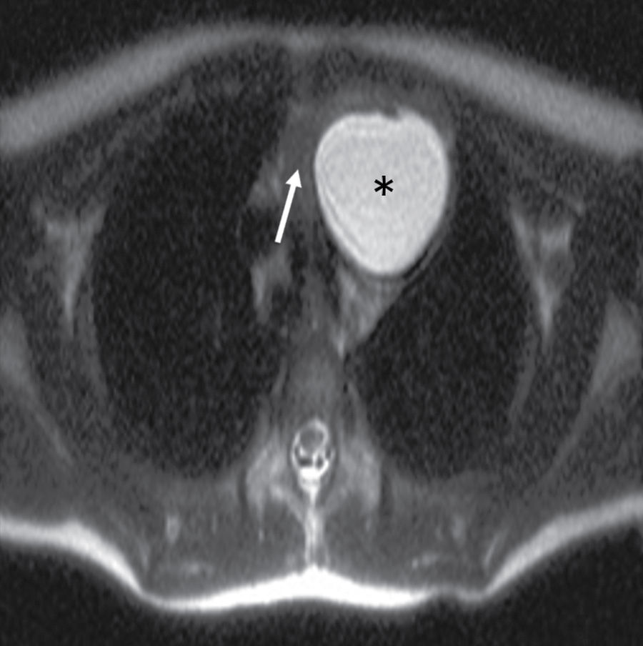 Cystic Lesions of the Head and Neck Radiology Key