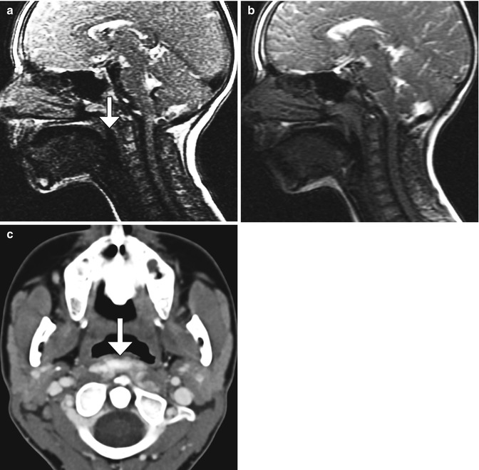 imaging-the-postoperative-neck-radiology-key