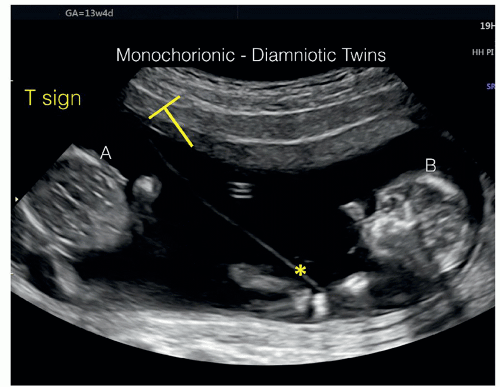 Congratulations, you're having a baby! Multiple Pregnancies In The First Trimester Radiology Key