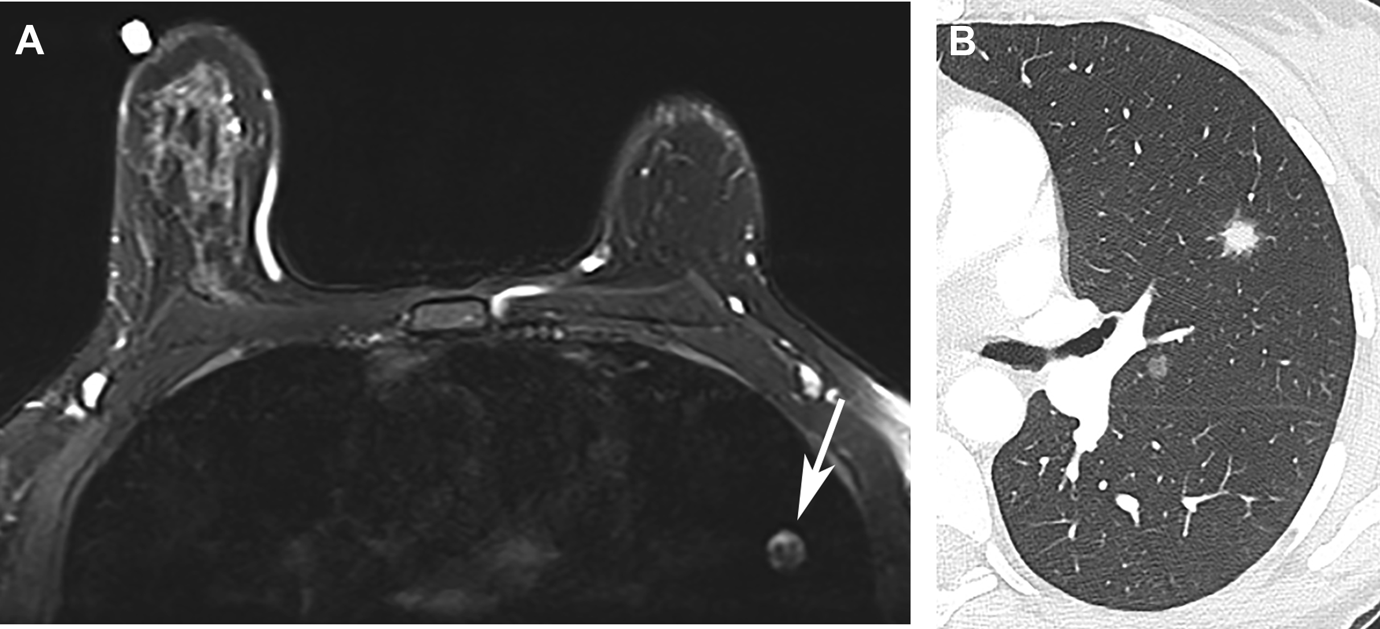 Incidental lung nodules on cross-sectional imaging