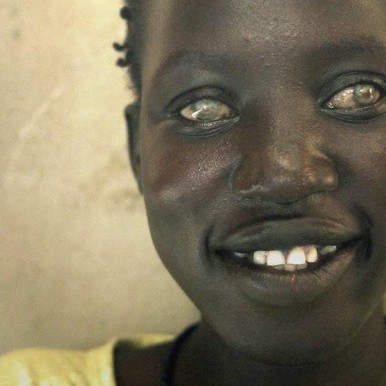 It is transmitted through repeated bites by black flies of the genus simulium. About 250 people suffer from River Blindness disease in