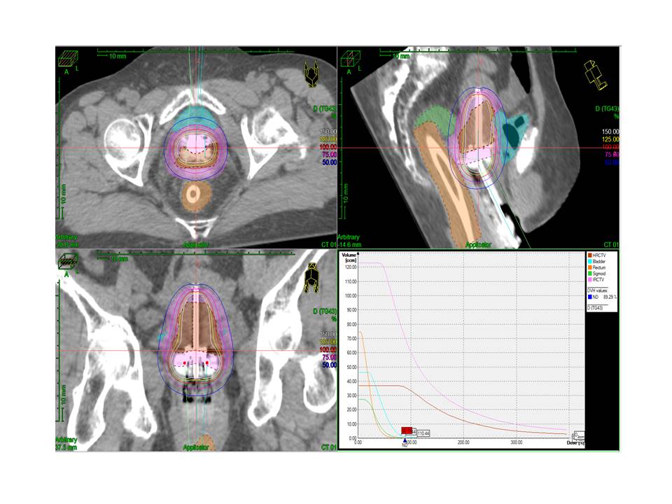 The plain radiographs may either be unremarkable or may demonstrate a radiolucent soft tissue mass of fat opacity. Layanan Unggulan Unit Pelayanan Onkologi Radiasi