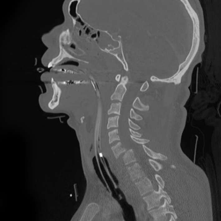 Snow mobile accident - cervical spine dislocation - radRounds Radiology ...