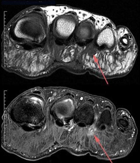 Morton's Neuroma - radRounds Radiology Network