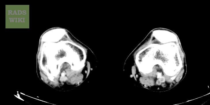 Deep Vein Thrombosis (DVT) - CT Venogram Lower Extremities - radRounds ...