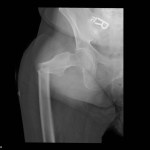 Right femur fracture with significant angulation