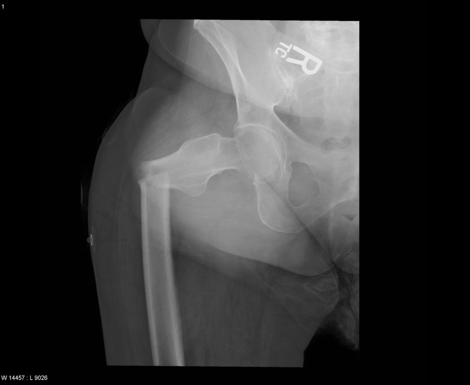 FractureRFemurWithSignificantAngulation